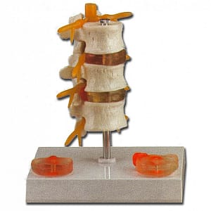 Modello patologia ernia