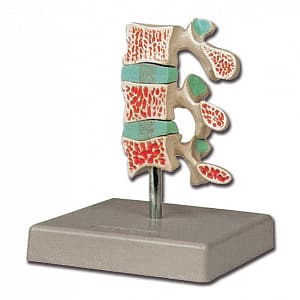 Modello osteoporosi